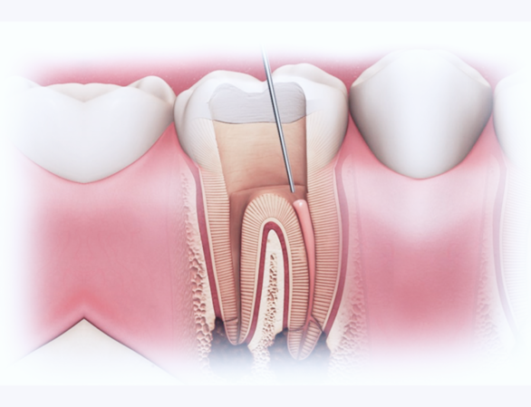 Лечение гранулёмы зуба